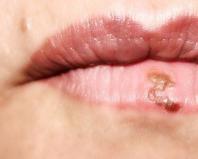 Что делать, если очень сильно трескаются и шелушатся губы